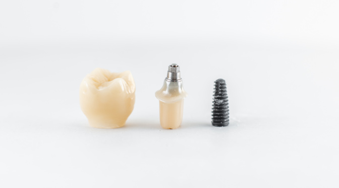 6 consideraciones sobre implante dental